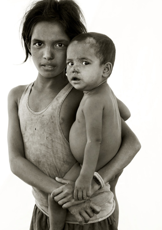 Rohingya's Refugees. Fatima, 10 with brother Noru. Noru has skin infections caused by malnutrition.