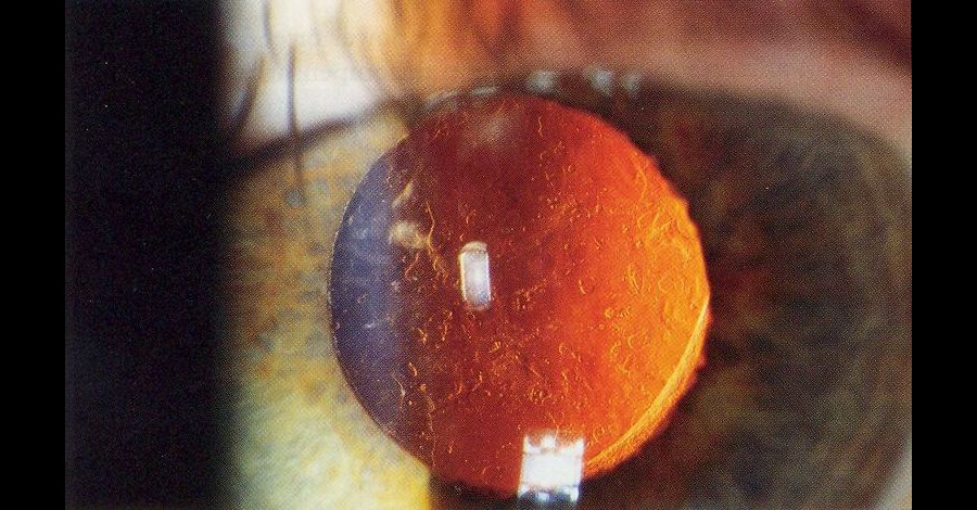 (1949) A lens to prevent blindness. As Molly Stevens describes, opthalmologist Sir Harold Ridley found that many fighter pilots had shards of plastic in their eyes after WWII. It turned out to be material from their planes -- yet it had caused no inflammation or irritation. Ridley eventually used the same plastic to create intraocular lenses for the treatment of cataracts. The first implant into a human eye was done in 1949. “We've revolutionized this necessity to go blind via this remarkable lens,” says Buddy Ratner. (Side note: Leonardo da Vinci sketched the concept of a contact lens for the surface of the eye in 1508; the first mass market version was also developed in 1949.)